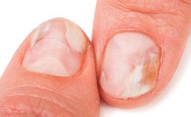 Verfärbte und verformte Nägel?