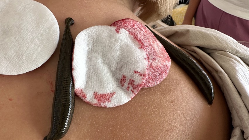 Heilende Blutsauger? Der Nacken, der zum Buffet wurde Heilende Blutsauger? Der Nacken, der zum Buffet wurde