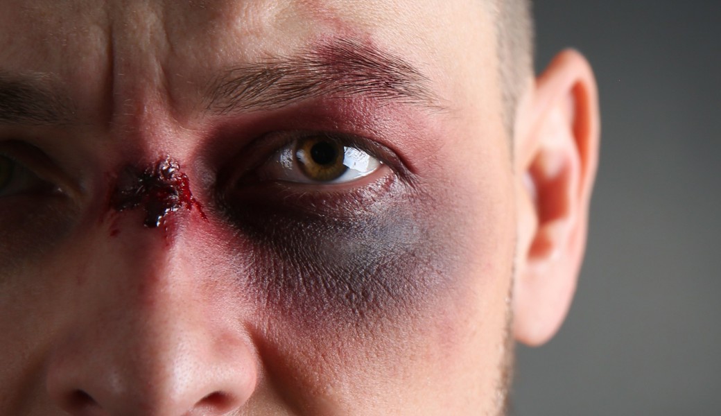 Ein 21-Jähriger erlitt bei der Attacke eines Unbekannten schwere Gesichtsverletzungen.