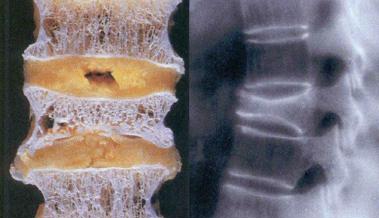 Dichte Knochen  oder Osteoporose?