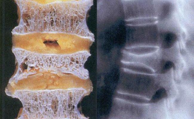 Dichte Knochen  oder Osteoporose?
